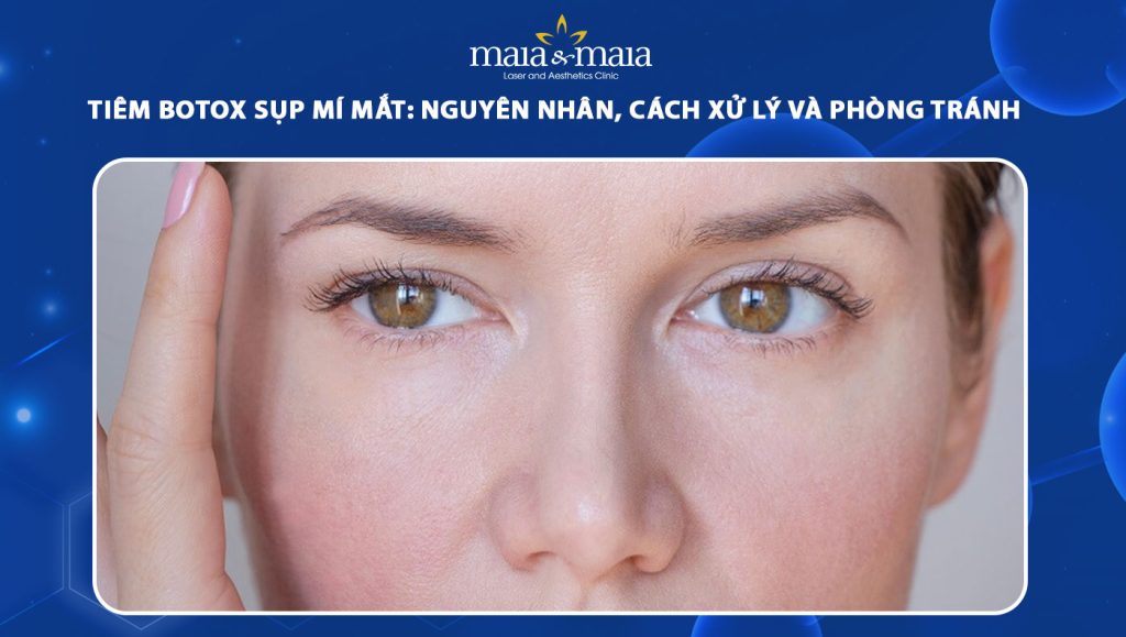 tiêm botox sụp mí mắt