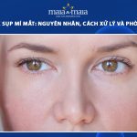tiêm botox sụp mí mắt
