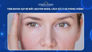 Tiêm botox sụp mí mắt: Nguyên nhân, cách xử lý và phòng tránh hiệu quả 59 tiêm botox sụp mí mắt