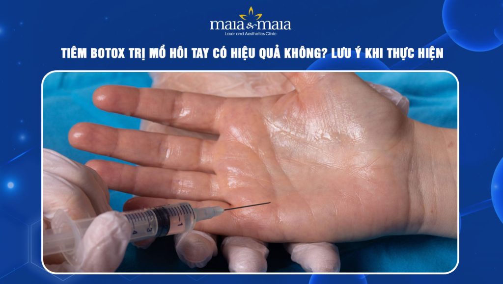 Tiêm botox trị mồ hôi tay