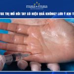 Tiêm botox trị mồ hôi tay