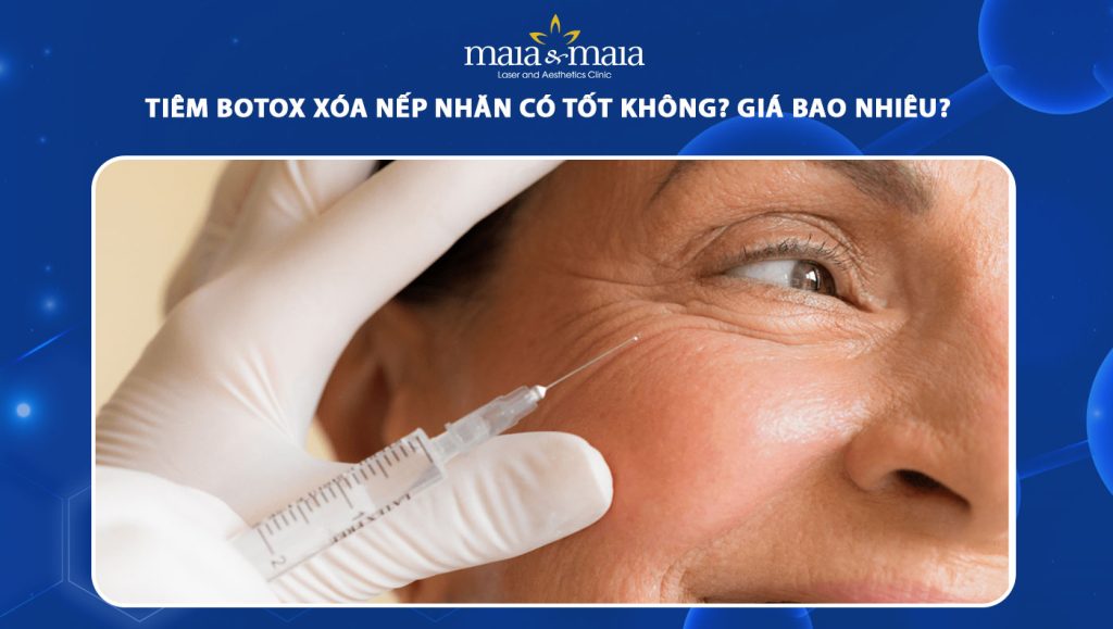 tiêm botox xóa nếp nhăn