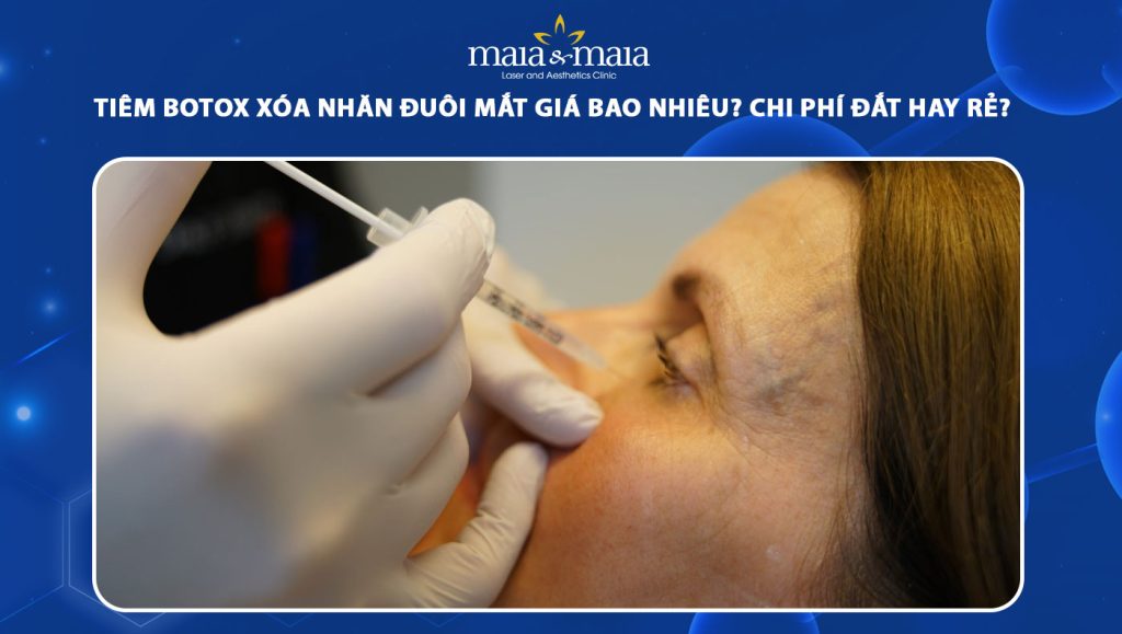tiêm botox xóa nhăn đuôi mắt giá bao nhiêu
