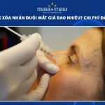 tiêm botox xóa nhăn đuôi mắt giá bao nhiêu