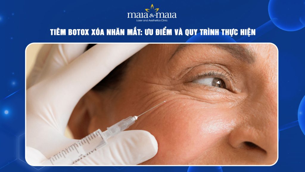 tiêm botox xoá nhăn mắt
