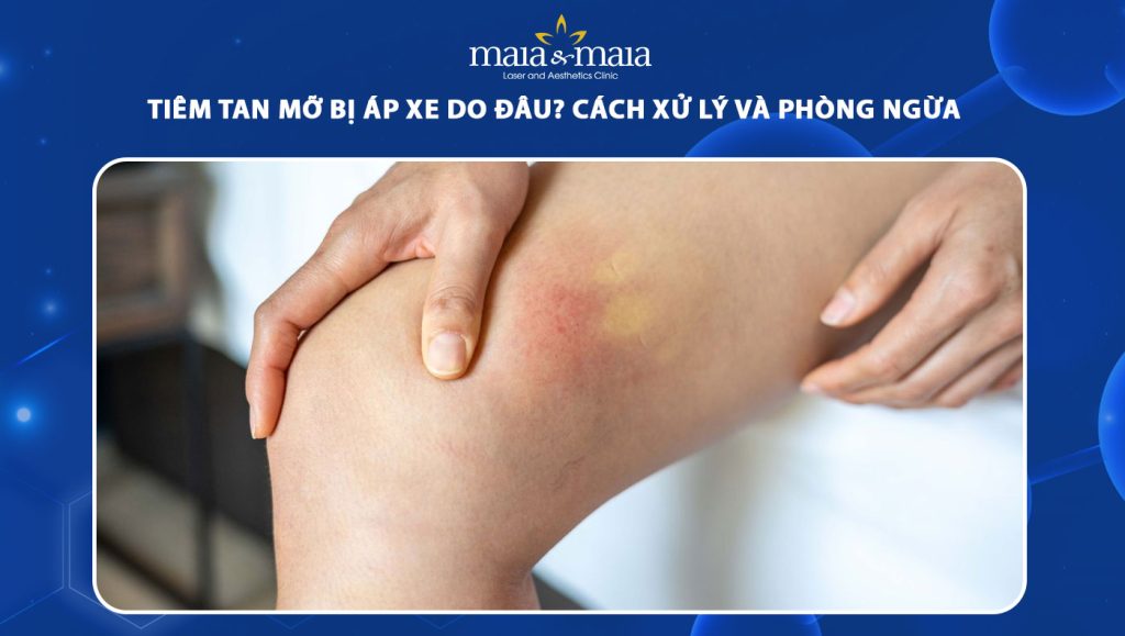 tiêm tan mỡ bị áp xe