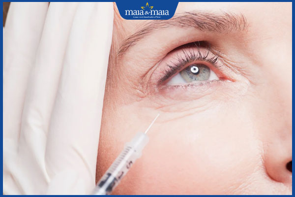 Tiêm botox xóa nhăn mắt: Ưu điểm và quy trình thực hiện 2 tiêm xóa nhăn vùng mắt