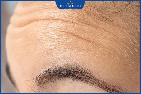 Bật mí 14 thói quen xấu gây nếp nhăn, lão hóa da nhanh chóng 2 trán có nếp nhăn