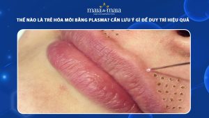 Thế nào là trẻ hóa môi bằng plasma? Cần lưu ý gì để duy trì hiệu quả lâu dài? 79 trẻ hóa môi bằng plasma