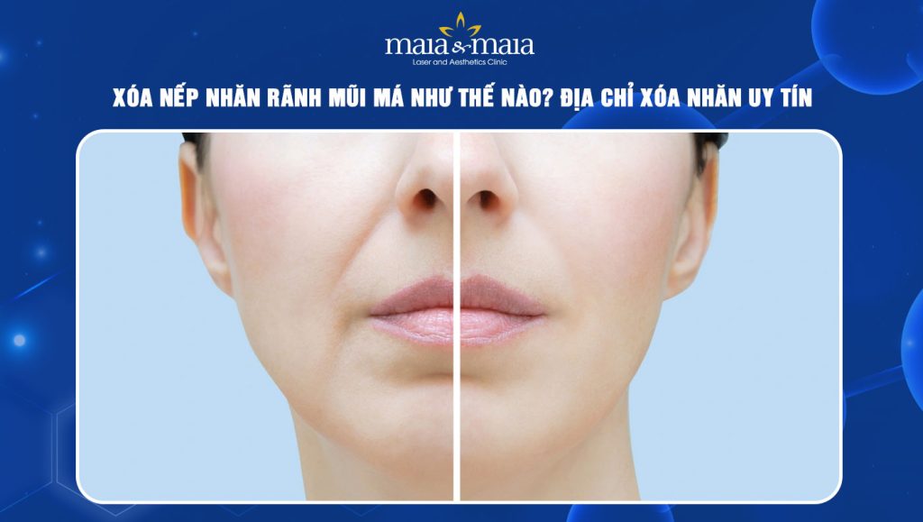 xóa nếp nhăn rãnh mũi má