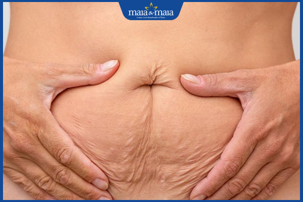 Nếp nhăn ở bụng có xóa bỏ được không? Bật mí địa chỉ thẩm mỹ uy tín hàng đầu  2 xuất hiện nếp nhăn ở bụng