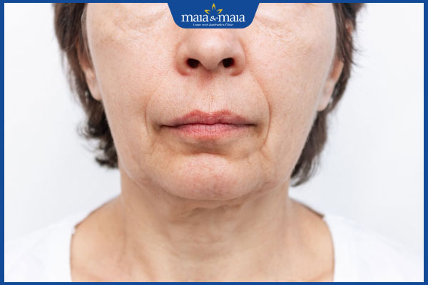 Da mặt chảy xệ: Nguyên nhân và các phương pháp cải thiện hiệu quả 2 da mặt nhăn nheo