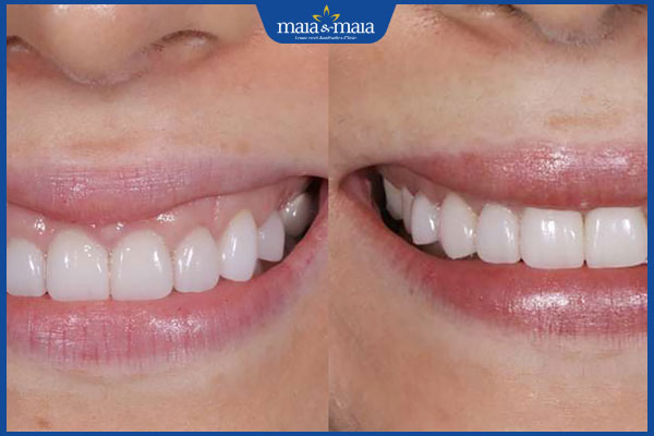 Tiêm botox cười hở lợi có tốt không? Bao lâu thấy hiệu quả? 4 hiệu quả sau tiêm botox cười hở lợi