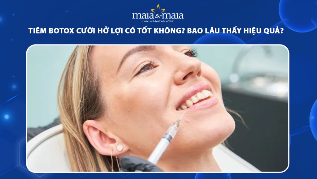 tiêm botox cười hở lợi