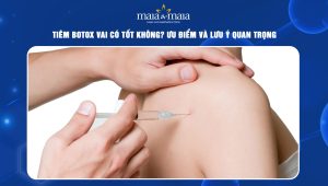 Tiêm botox vai có tốt không? Ưu điểm và lưu ý quan trọng 36 Tiêm botox vai