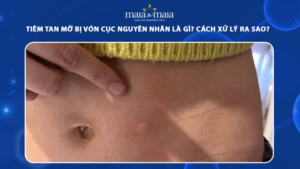 tiêm tan mỡ bị vón cục