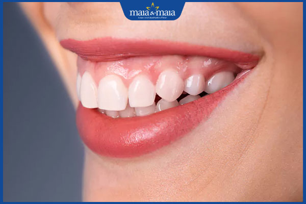 Tiêm botox cười hở lợi có tốt không? Bao lâu thấy hiệu quả? 2 tình trạng cười hở lợi