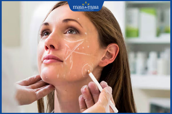 Tiêm filler mặt lệch: Giải pháp cho gương mặt cân đối không phẫu thuật 5 xác định vị trí tiêm