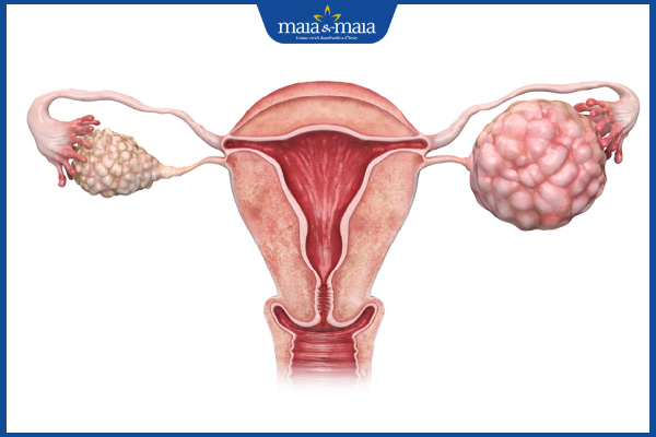 buồng trứng đa nang