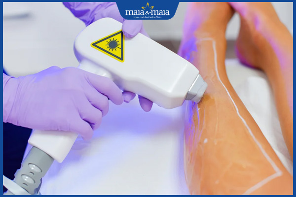 Triệt lông xong bị viêm nang lông: Nguyên nhân và cách điều trị  2 công nghệ triệt lông lạnh