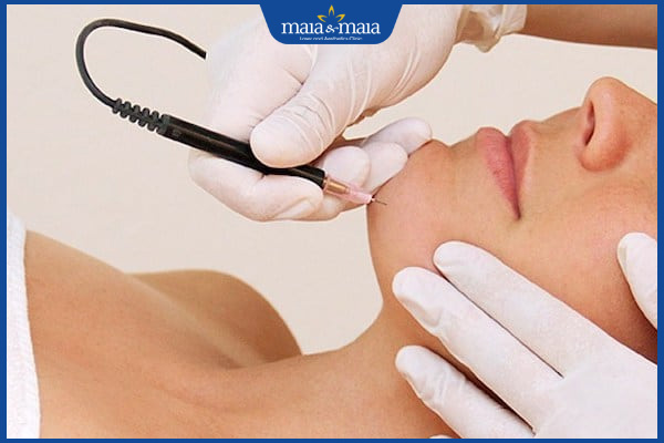 điện phân triệt lông