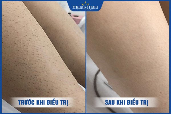 khách triệt lông chân maia