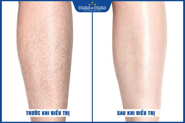 khách triệt lông chân