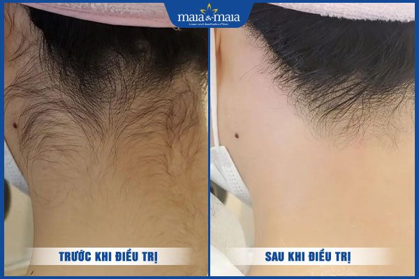 khách triệt lông gáy