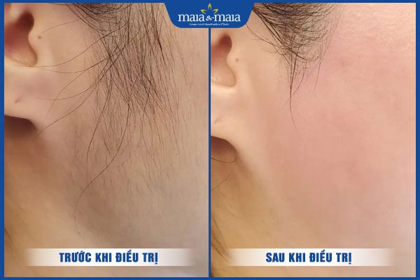 khách triệt lông mặt