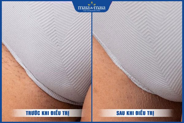 khách triệt lông mu