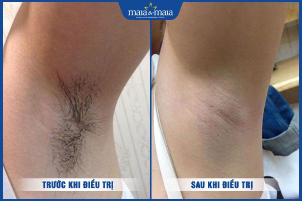 khách triệt lông nách