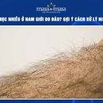 Lông mọc nhiều ở nam giới