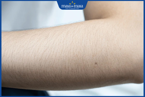 Triệt lông đầu lạnh có ưu điểm gì? Lưu ý trước và sau khi thực hiện 3 lông trên tay