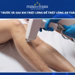 lưu ý trước và sau khi triệt lông