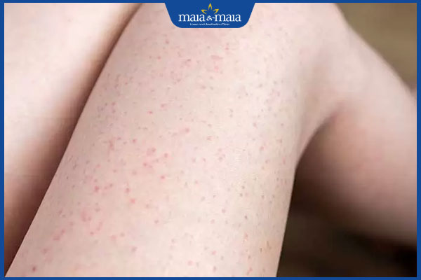Triệt lông bị nổi mẩn đỏ phải làm sao? Địa chỉ triệt lông uy tín 2 mẩn đỏ sau triệt lông