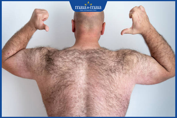 Rậm lông có đáng lo ngại không? Cách xử lý và kiểm soát hiệu quả 3 nam rậm lông