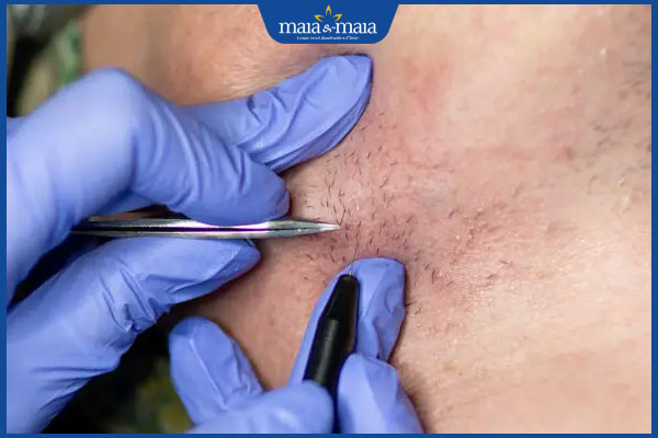 Đàn ông có nên triệt lông? Gợi ý phương pháp triệt lông hiệu quả 3 nam triệt lông điện phân