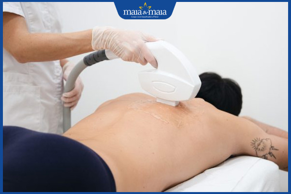 Đàn ông có nên triệt lông? Gợi ý phương pháp triệt lông hiệu quả 4 nam triệt lông ipl