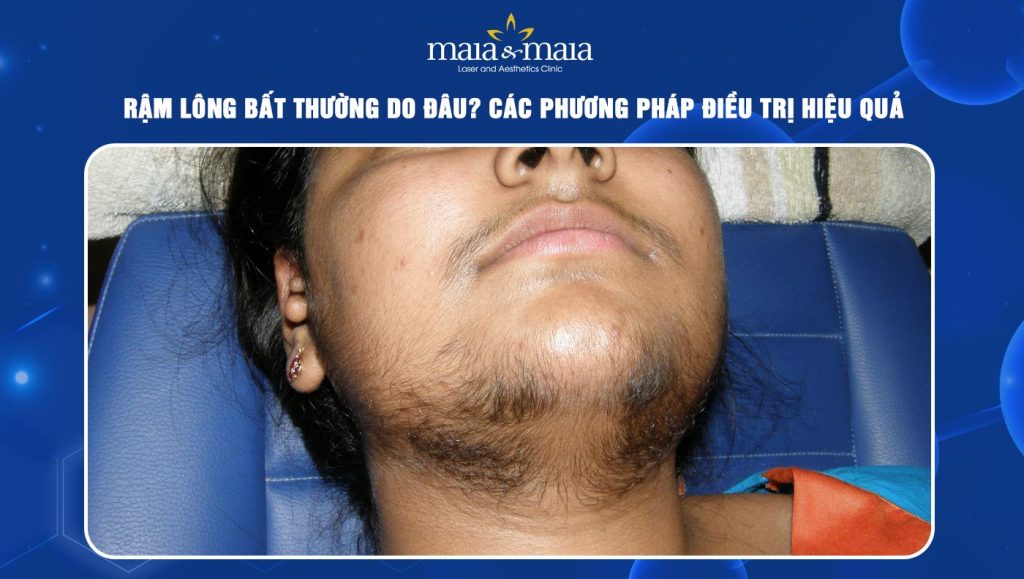 Rậm lông bất thường
