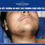 Rậm lông bất thường