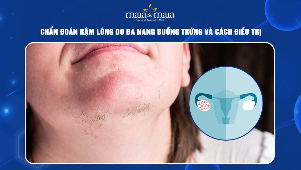 rậm lông do đa nang buồng trứng
