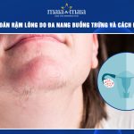 rậm lông do đa nang buồng trứng