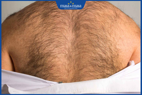 Lông mọc nhiều ở nam giới do đâu? Gợi ý cách xử lý hiệu quả 2 rậm lông nam gây cản trở