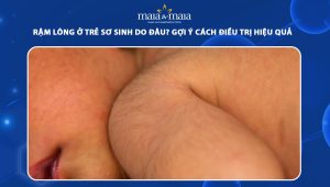 Rậm lông ở trẻ sơ sinh do đâu? Gợi ý cách điều trị hiệu quả 91 rậm lông ở trẻ sơ sinh