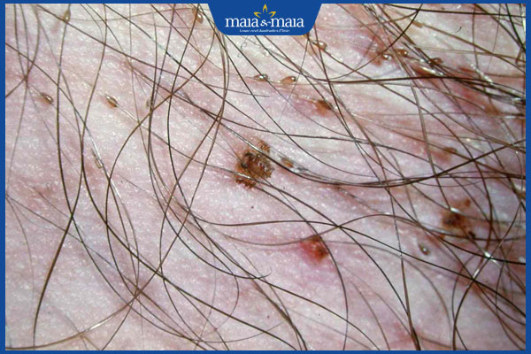 Ngứa lông mu do nguyên nhân gì? Cách xử lý và phòng ngừa hiệu quả 2 rận mu