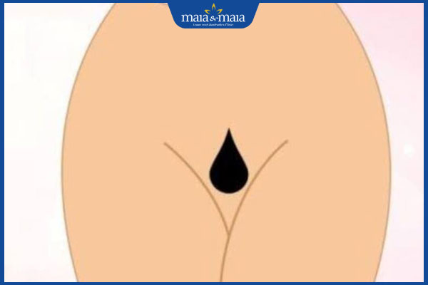 Gợi ý cách triệt lông bikini tạo hình giọt nước đúng cách, đơn giản 2 tạo hình lông bikini giọt nước