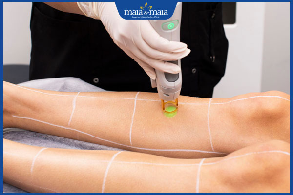 tiến hành triệt lông