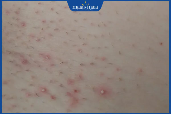 Chuyên gia tư vấn triệt lông xong có được bôi kem chống nắng không? 2 tình trạng da sau triệt lông