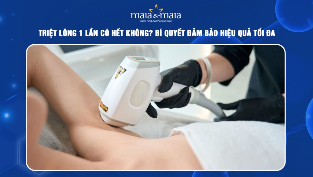 triệt lông 1 lần có hết không