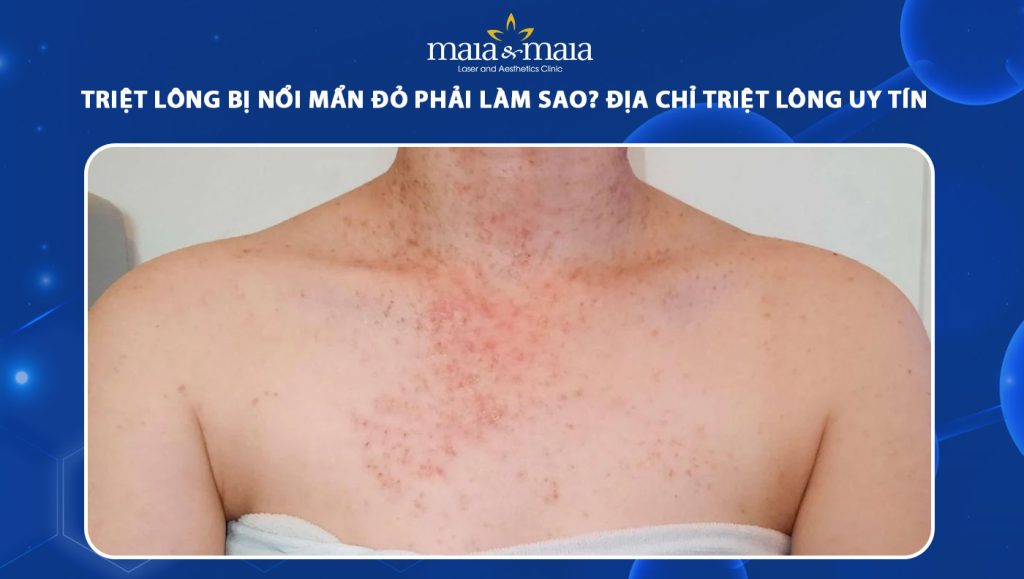 triệt lông bị nổi mẩn đỏ